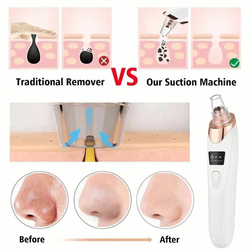 Blackhead Remover Vacuum – Deep Pore Facial Cleanser